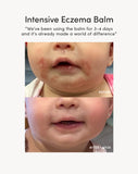 Complete Eczema Care Set