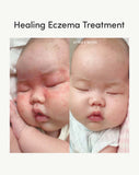 Complete Eczema Care Set